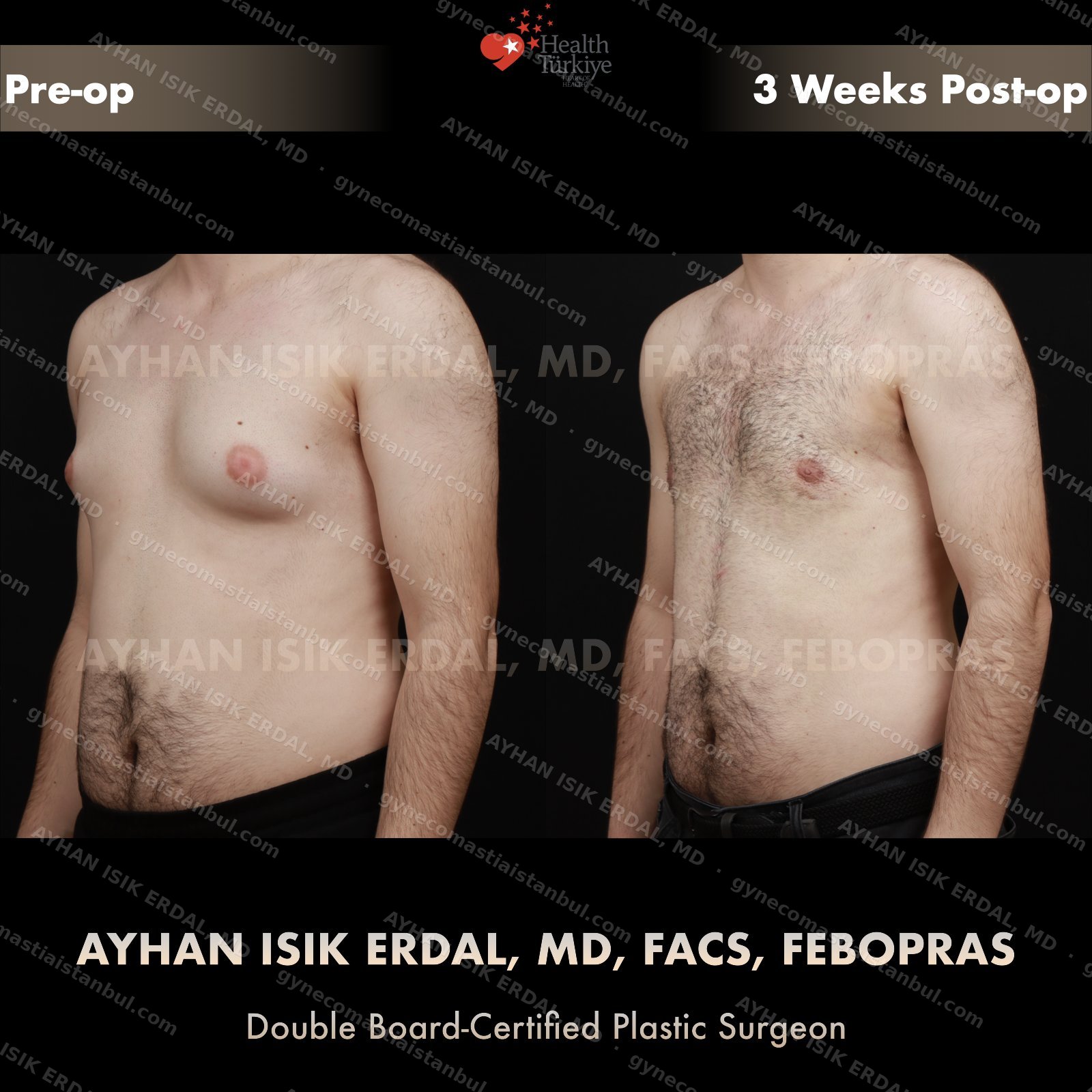 Gynecomastia before and after — oblique view, 3 weeks post-op