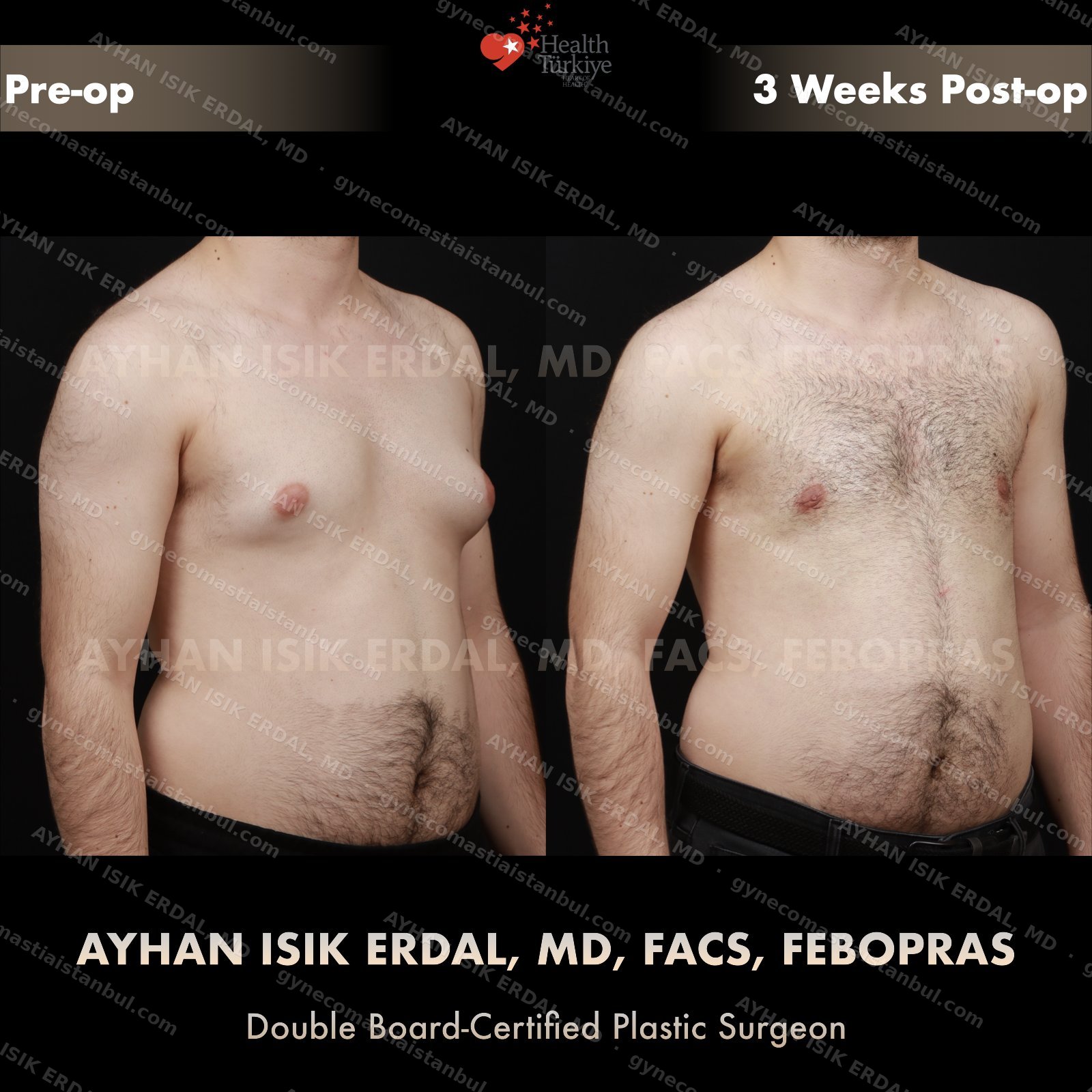 Gynecomastia before and after — lateral view, 3 weeks post-op