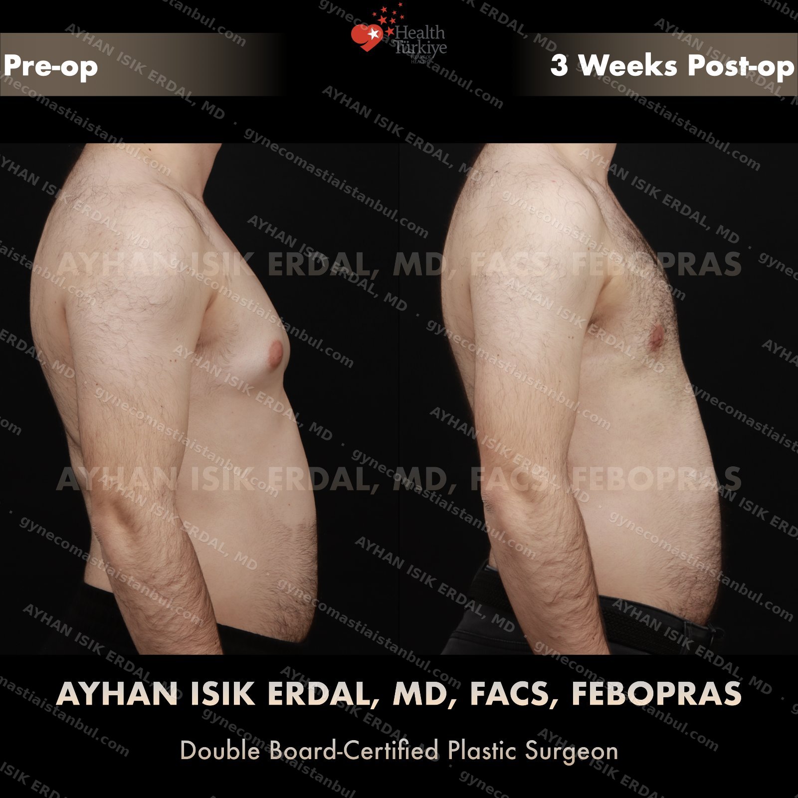 Gynecomastia before and after — lateral view, 3 weeks post-op