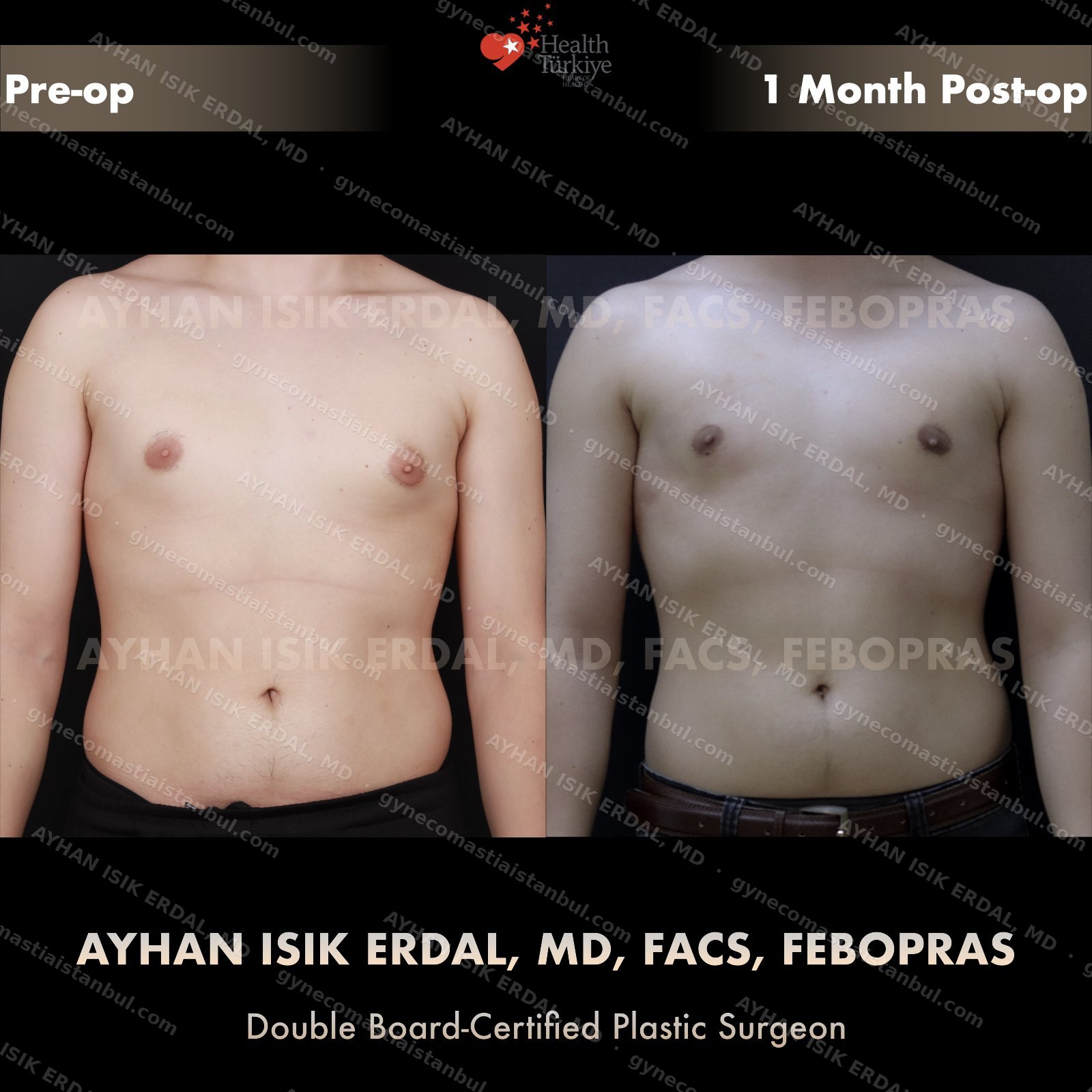 Gynecomastia before and after — frontal view, 1 month post-op
