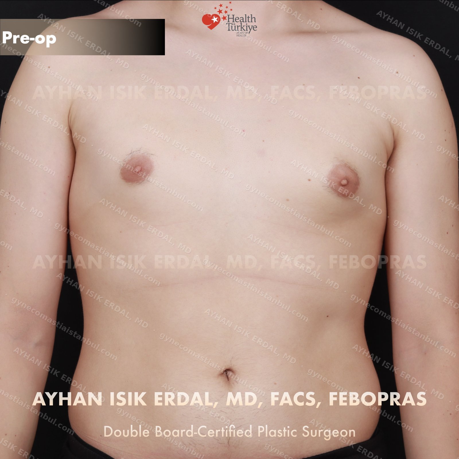 Gynecomastia before and after — oblique view, 1 month post-op