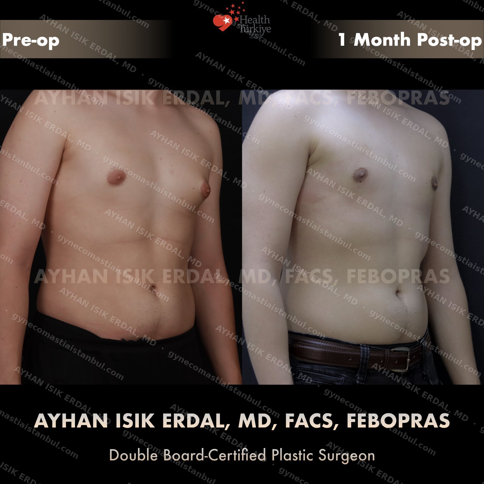 Gynecomastia before and after — lateral view, 1 month post-op