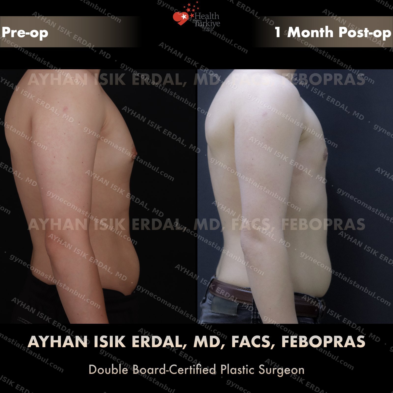 Gynecomastia before and after — lateral view, 1 month post-op
