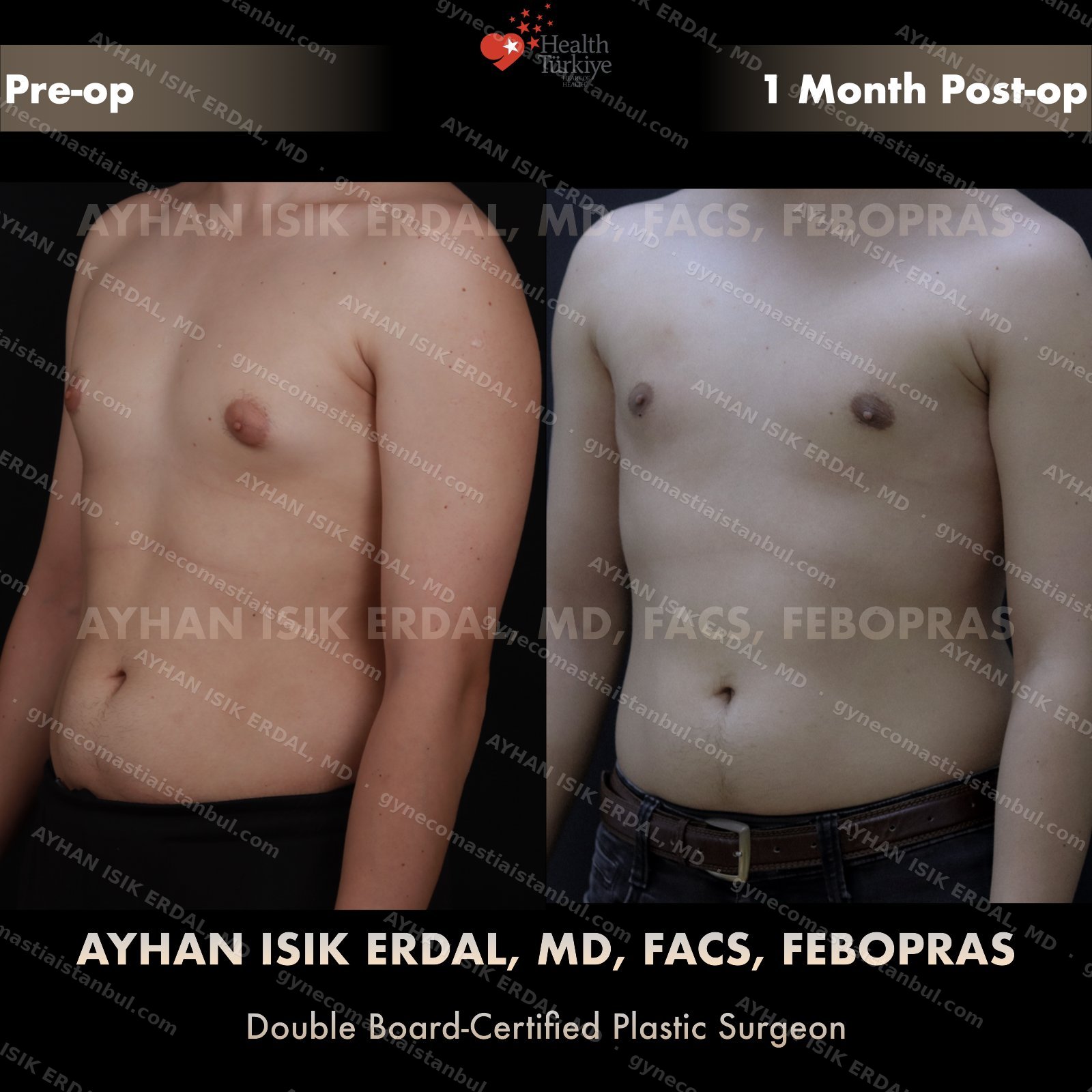 Gynecomastia before and after — posterior view, 1 month post-op