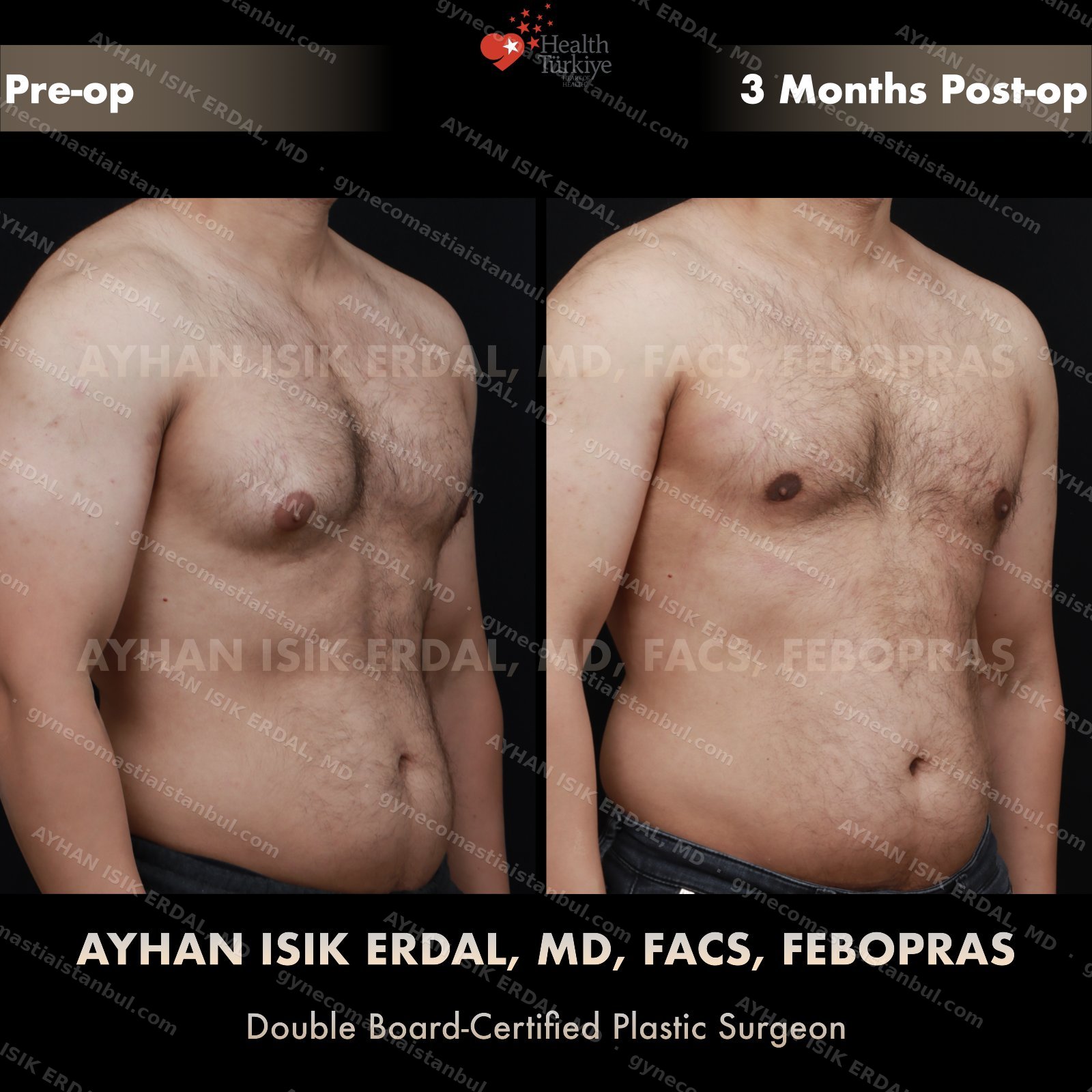 Gynecomastia before and after — oblique view, 3 months post-op