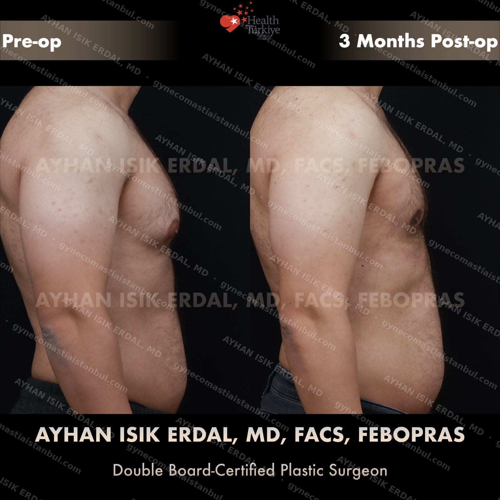 Gynecomastia before and after — lateral view, 3 months post-op